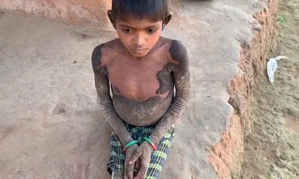 В Индии ребенок «окаменел» из-за редкой болезни