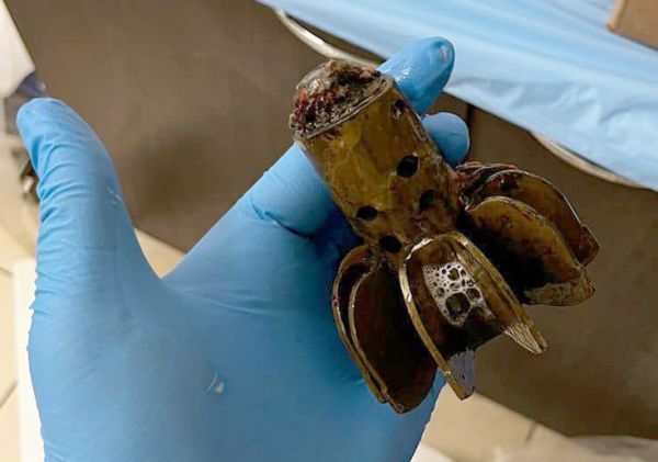 На операцию вызвали саперов: из тела военного медики извлекли хвостовик мины (фото)