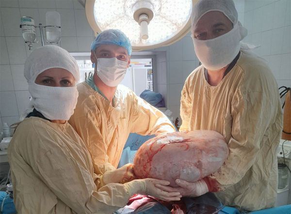Женщина, которой в Николаевском онкоцентре удалили 17-килограммовую опухоль, сбежала из больницы на третий день после операции (фото)